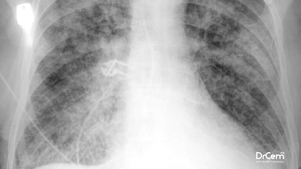 Pulmoner Ödem görseli - DrCem hastalık rehberi
